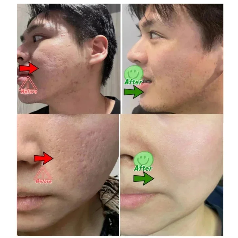 Crema limpiadora de poros de á - Salicylic Acid Blackhead Remover reseña y precio
