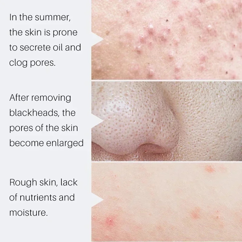 Suero Reductor de Poros con Ác - Salicylic Acid Blackhead Remover reseña y precio