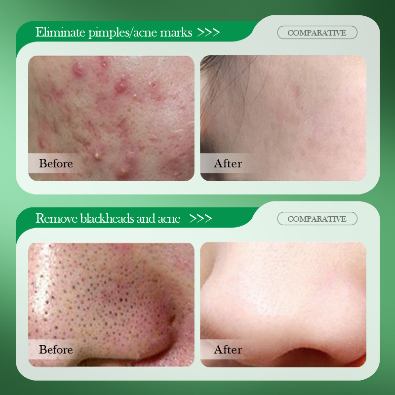 Crema de Tratamiento para el A - Salicylic Acid Blackhead Remover reseña y precio
