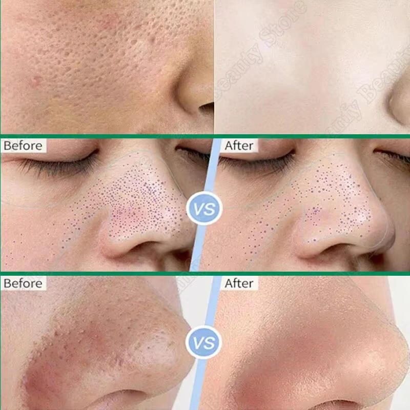 Crema Limpiadora de Poros con  - Salicylic Acid Blackhead Remover reseña y precio